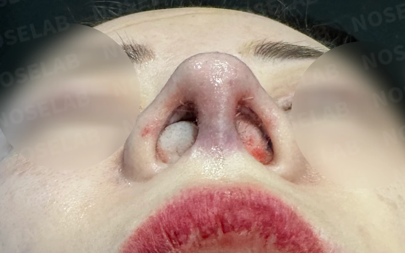 코막힘, 콧구멍비대칭 교정 사례 — 수술전(좌) 수술직후(우)