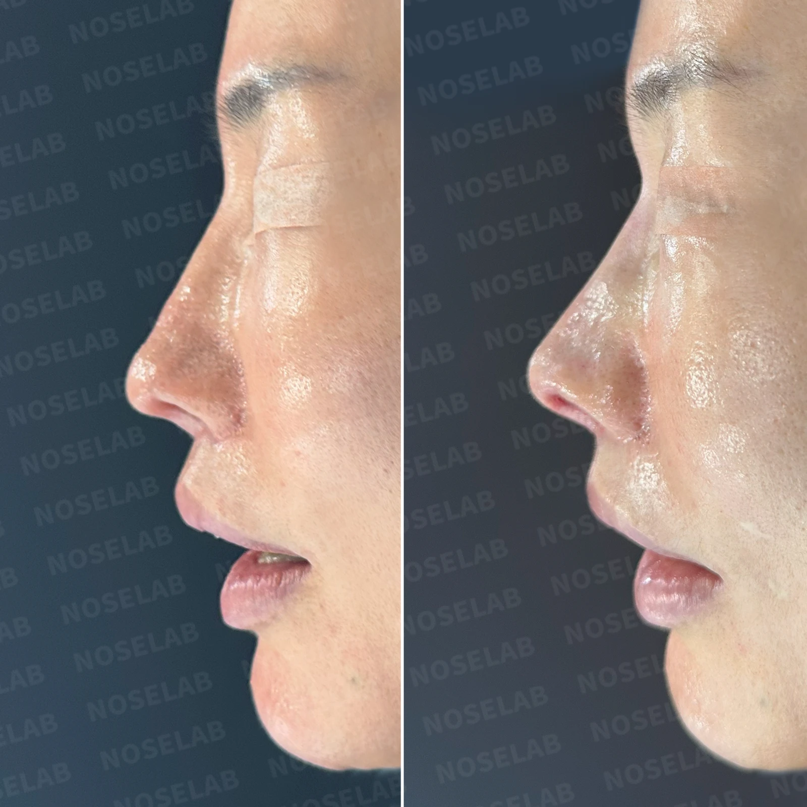 여러 차례 수술 뒤 비중격이 손상되면, 늑연골 재건은 어떻게 하나 — 본문 사진 20
