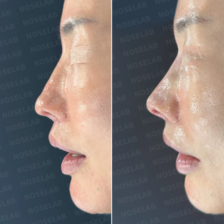 손상된 비중격 재건하며 완성한 자연스러운 코끝 — 전후 비교