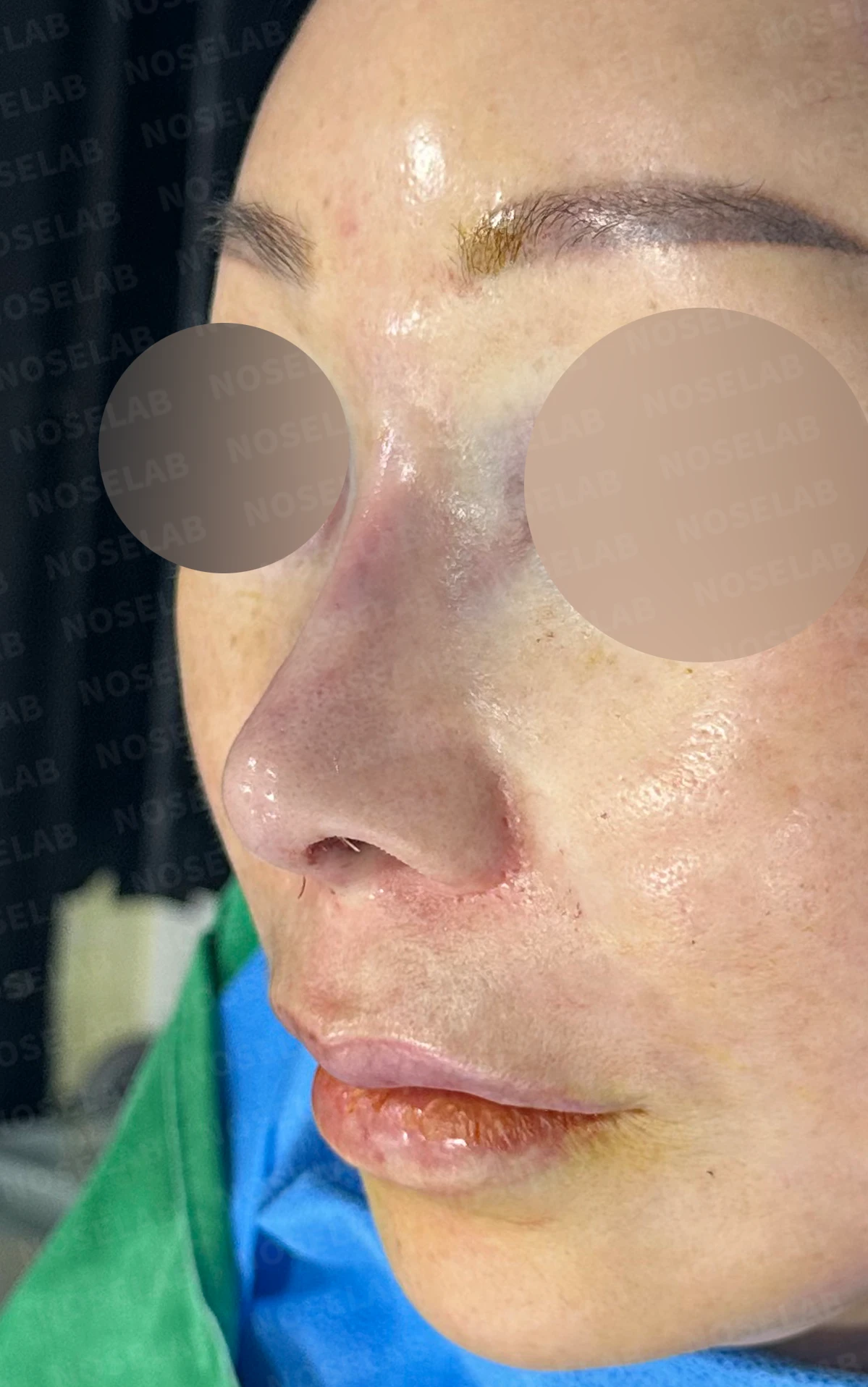 코 안에 남은 메드포어와 이물질, 왜 문제가 되고 어떻게 제거하나 — 수술 직후 0일 정면, 측면, 비스듬한 측면 사진 직후 사진은 부기가 있는 상태로 최종 결과와 다를 수 있습니다.