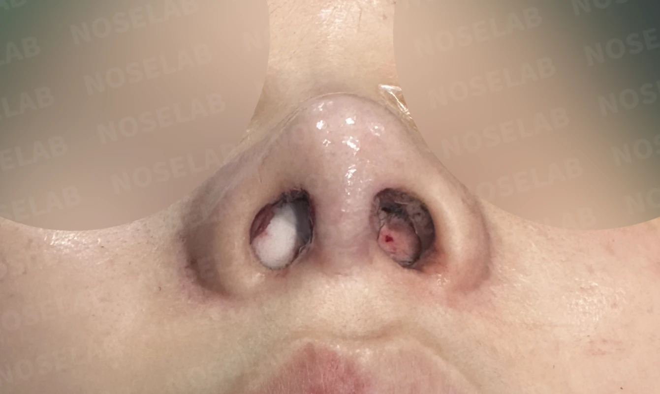 휘어진 코와 복코, 자가늑연골 비중격 재건으로 안전하게 교정한 코재수술 — 직후 비공 사진입니다.