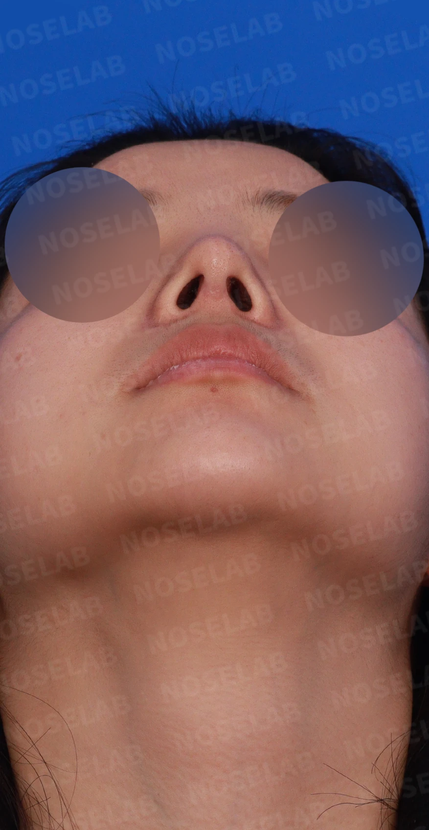 퍼진 콧대와 들린 코끝은 왜 생기나, 늑연골 재건은 어떻게 하나 — 디자인 상담 우측 비스듬한 측면, 측면, 비공 사진입니다.