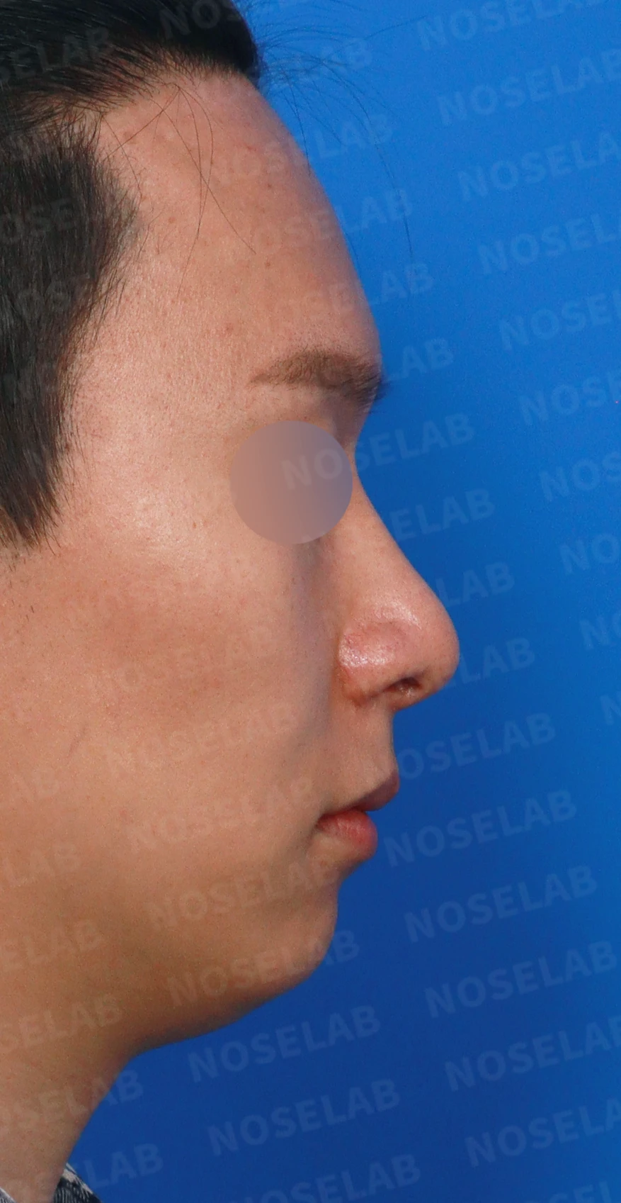 한쪽 비골이 함몰되면 왜 코가 휘어 보이는가, 절골 복원과 비중격 재건 — 디자인 상담 우측 측면, 비스듬한 측면, 비공 사진