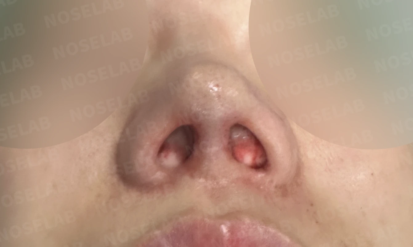 짧은 코와 복코, 자가늑연골로 세련되게 교정한 코재수술 — 직후 비공 사진입니다.