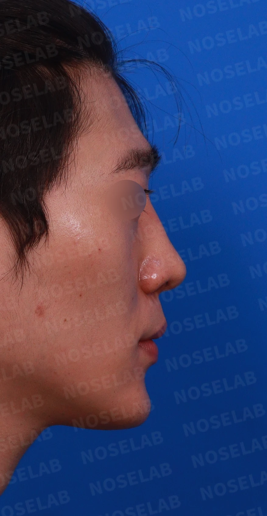 코골절과 반복 재수술 뒤 남는 흉터 조직과 비공 비대칭, 재건 방법 — 디자인 상담 우측 측면 , 비스듬한 측면 , 비공 사진입니다.