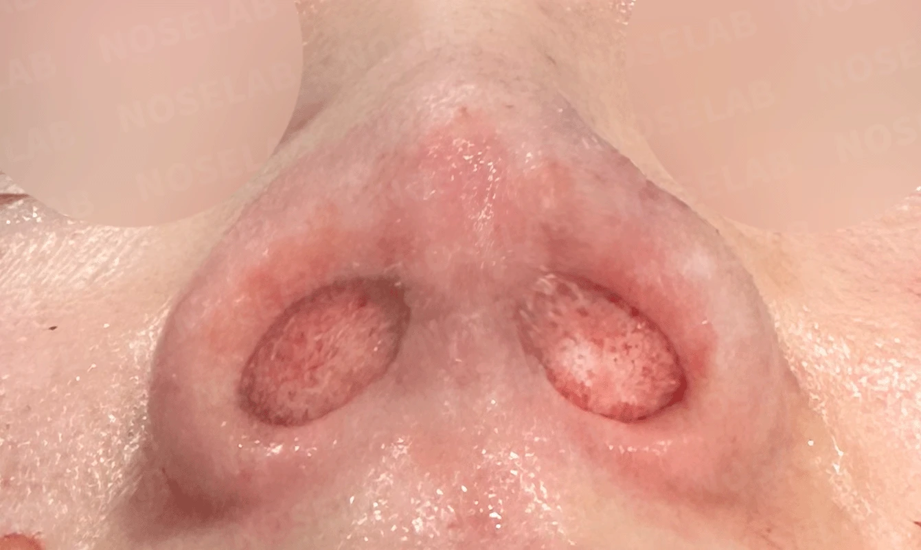 콧구멍을 막는 종괴가 생기는 이유, 제거와 재건은 어떻게 하나 — 본문 사진 22