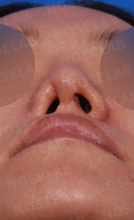 구순구개열에 동반된 코 변형의 교정 방법 — 디자인 상담 사진입니다. 비공, 우측 비스듬한 측면, 측면