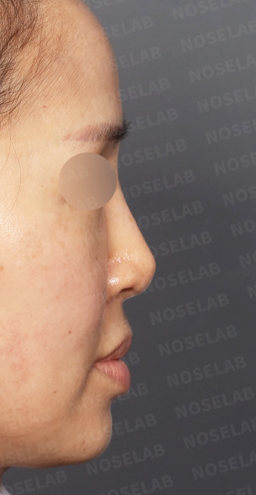 보형물 비침과 용코, 자가늑연골로 안전하게 교정한 코재수술 — 디자인 상담 우측 측면, 비스듬한 측면, 비공 사진입니다.