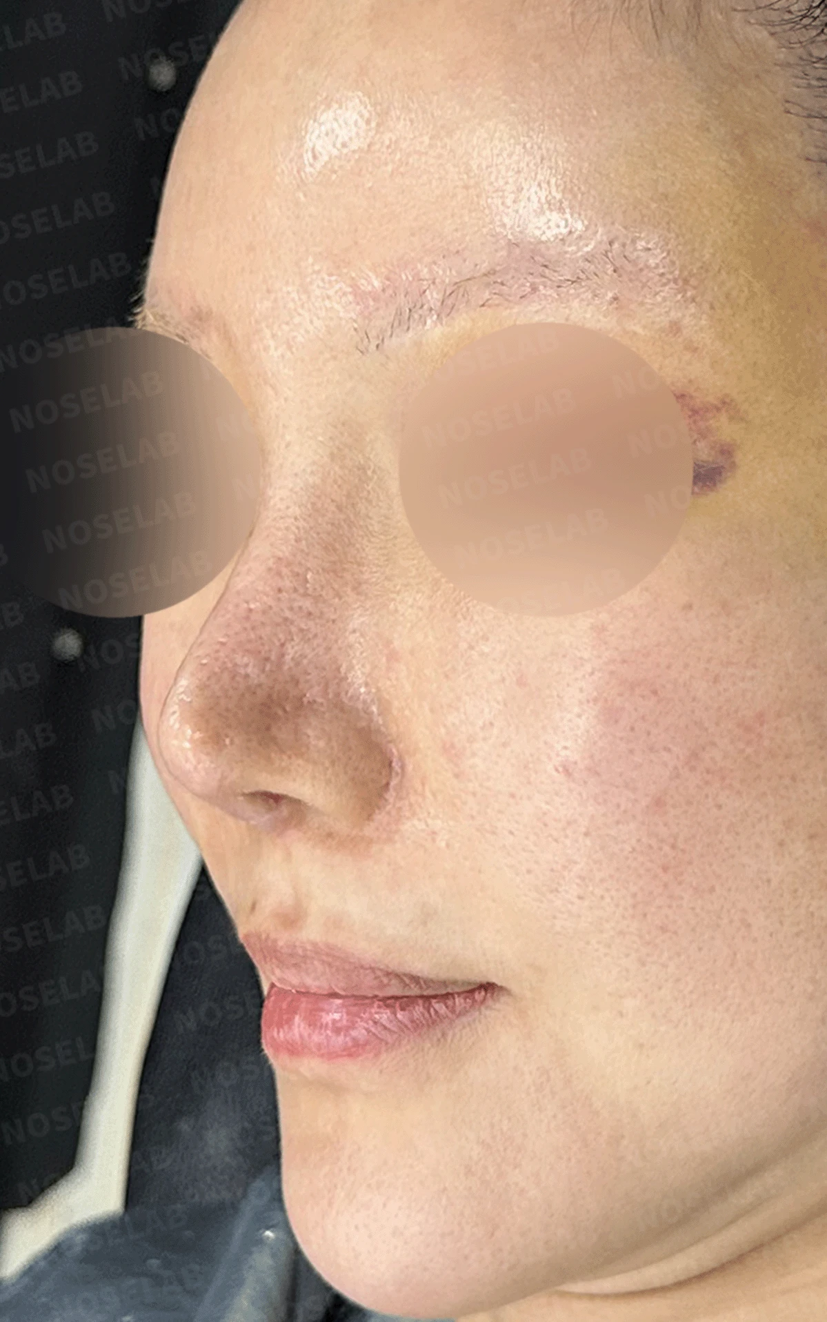 여러 차례 재수술로 코에 쓸 연골이 남지 않았을 때, 재건은 어떻게 하나 — 수술 직후 0일 정면 , 비스듬한 측면 , 측면 사진입니다. 직후 사진은 부기가 있는 상태로 최종 결과와 다를 수 있습니다.