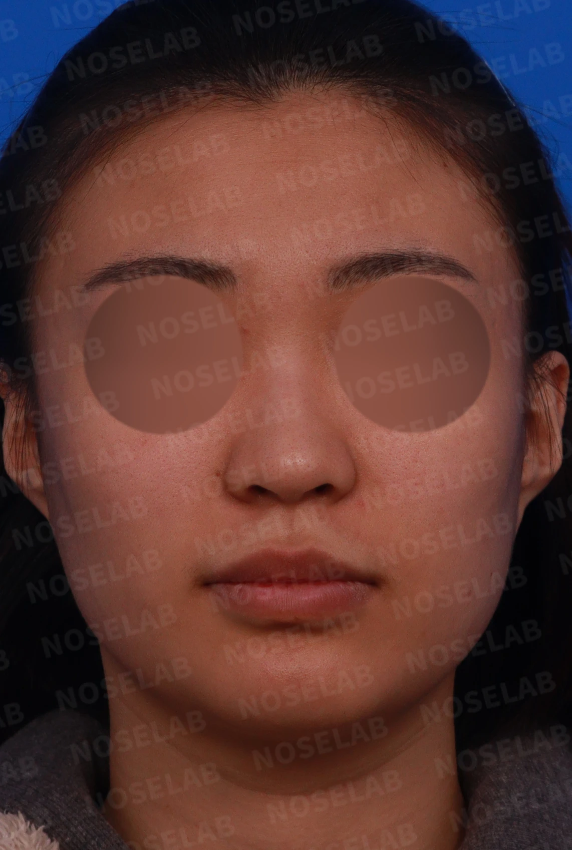 뭉툭하게 퍼진 코끝이 생기는 이유, 자가 늑연골 비중격 연장으로 직반 라인을 만드는 방법 — 디자인 상담 정면, 좌측 측면, 비스듬한 측면 사진