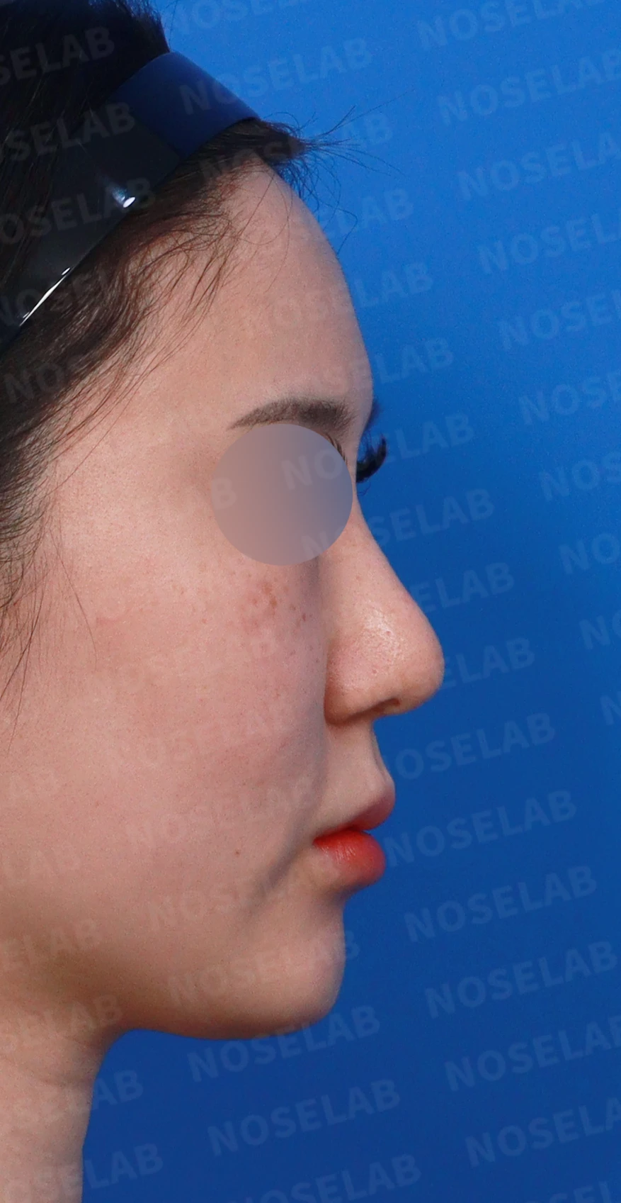 길고 뭉툭한 코, 자가늑연골로 화려하면서 자연스럽게 — 디자인 상담 우측 측면, 비스듬한 측면, 비공 사진입니다.