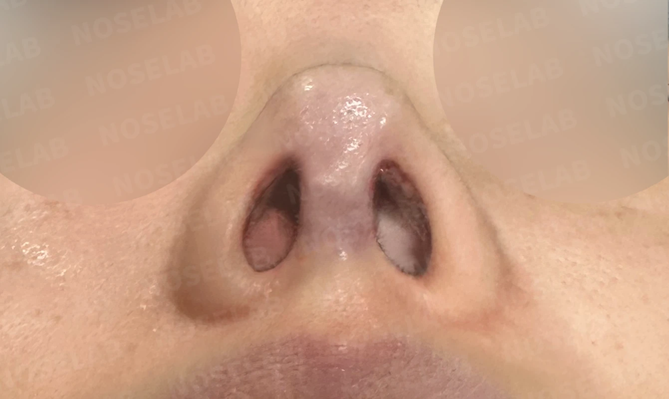 오래된 코성형 뒤 코끝이 들리고 콧구멍이 드러나는 이유, 제거와 자가진피 재건은 어떻게 하나 — 수술 직후 0일 비공사진입니다. 직후 사진은 부기가 있는 상태로 최종 결과와 다를 수 있습니다.