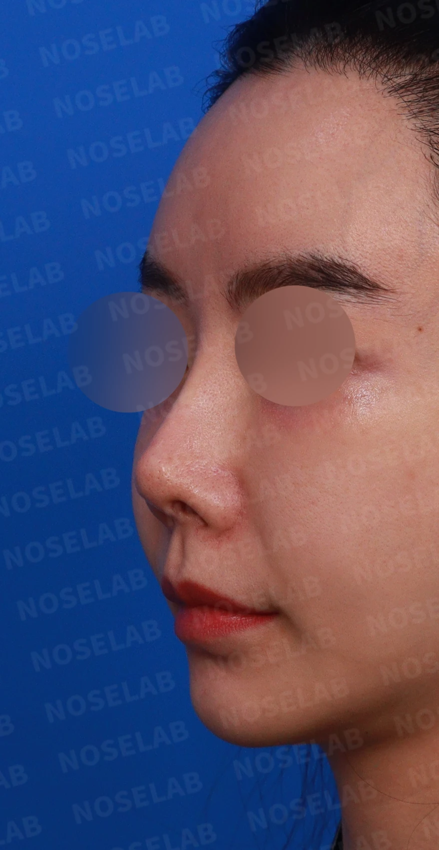 이식한 진피가 반복해서 흡수되는 이유, 재건은 어떻게 하나 — 디자인 상담 정면, 좌측 측면, 비스듬한 측면 사진입니다.