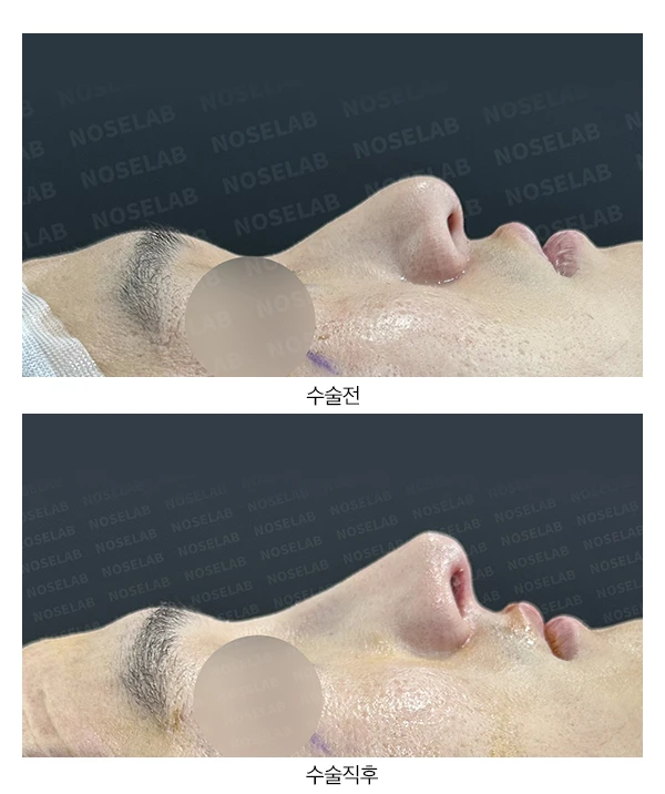 휜코 교정하면 안면 비대칭이 좋아질까요? — 전후 비교