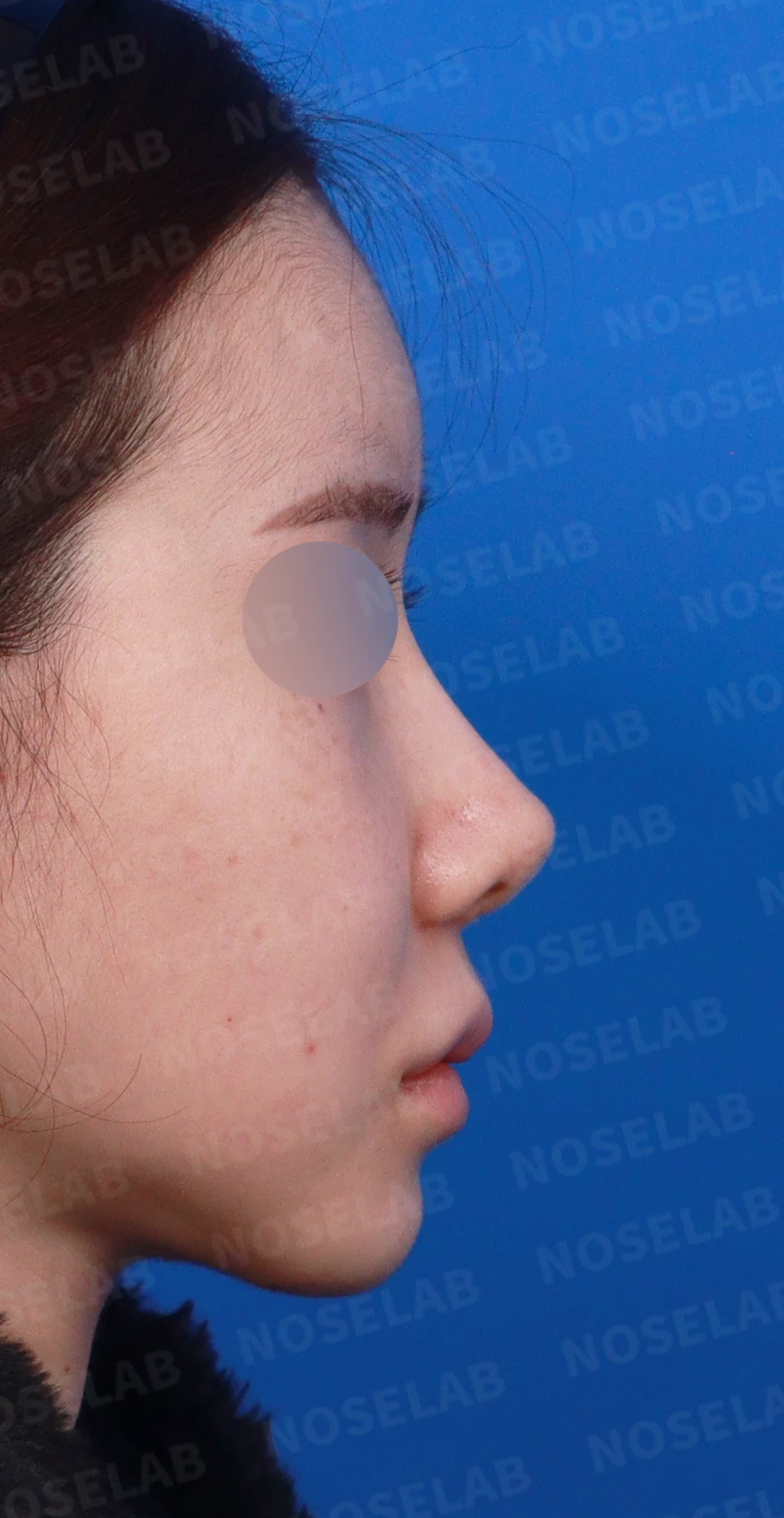 코성형 뒤 코끝이 들리고 비주가 짧아 보이는 이유, 비주 하강과 콧대 라인 교정 방법 — 디자인 상담 우측 측면, 비스듬한 측면, 비공 사진입니다.