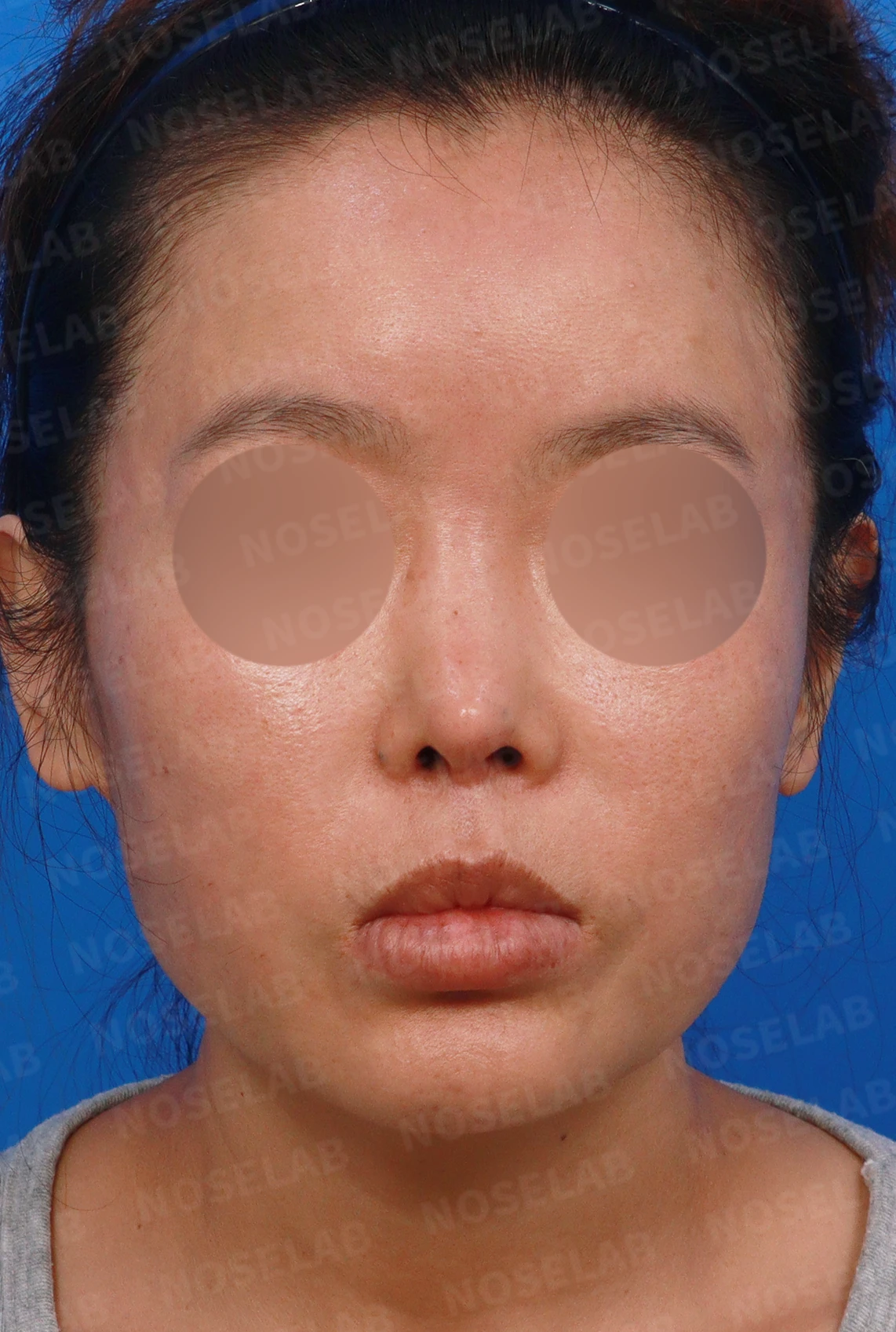 이식한 진피가 흡수되어 콧대가 퍼지고 코가 들려 보이는 이유와 교정 방법 — 디자인 상담 정면, 좌측 측면, 비스듬한 측면 사진입니다.