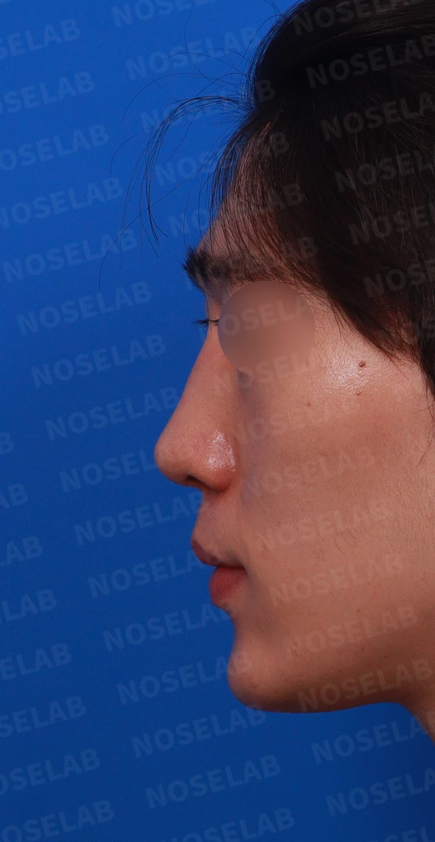 코골절과 반복 재수술 뒤 남는 흉터 조직과 비공 비대칭, 재건 방법 — 디자인 상담 정면 , 좌측 비스듬한 측면 , 측면 사진입니다.