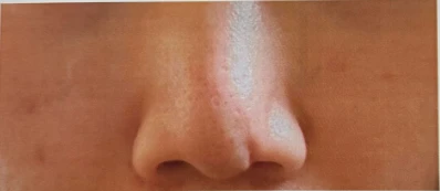 콧구멍을 막는 종괴가 생기는 이유, 제거와 재건은 어떻게 하나 — 본문 사진 5