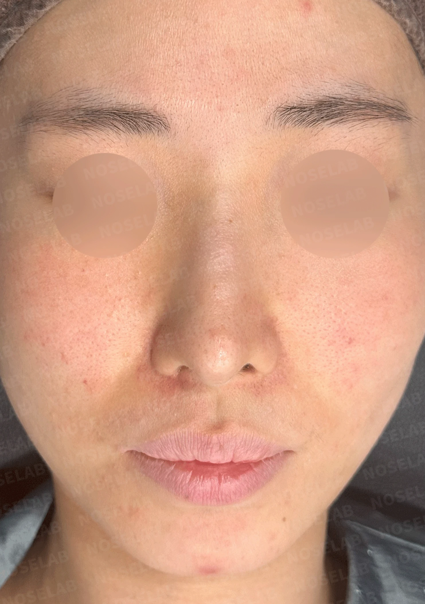 코성형 절골 후 콧등이 꺼지고 한쪽이 막히는 이유, 비밸브 재건과 복원 — 본문 사진 9