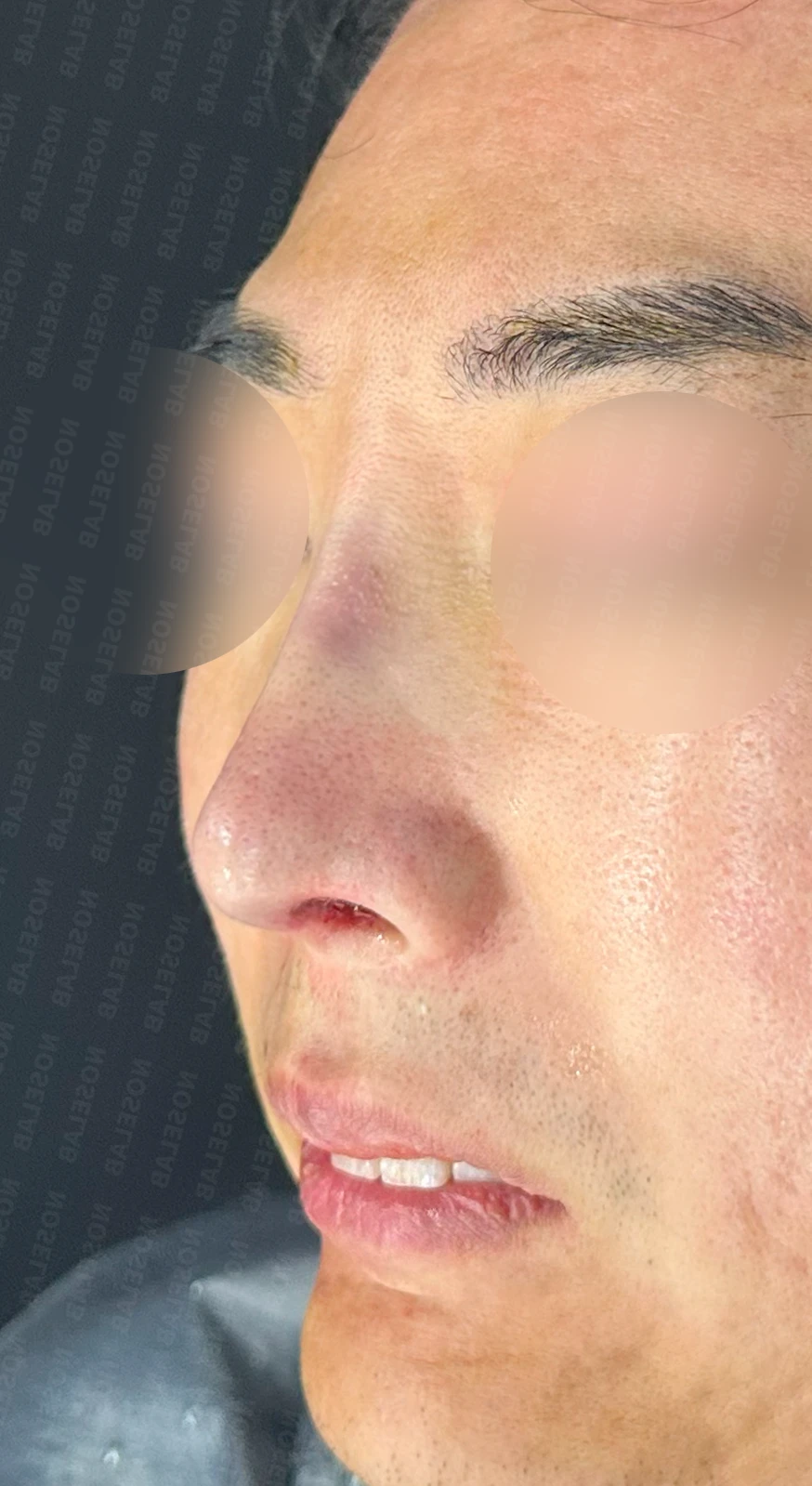 매부리코 수술 후 비대칭의 재수술 방법 — 수술 전 / 수술 직후 0일 직후 사진은 부기가 있는 상태로 최종 결과와 다를 수 있습니다.