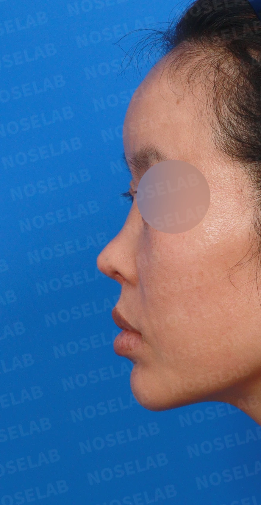 이식한 진피가 흡수되어 콧대가 퍼지고 코가 들려 보이는 이유와 교정 방법 — 디자인 상담 정면, 좌측 측면, 비스듬한 측면 사진입니다.