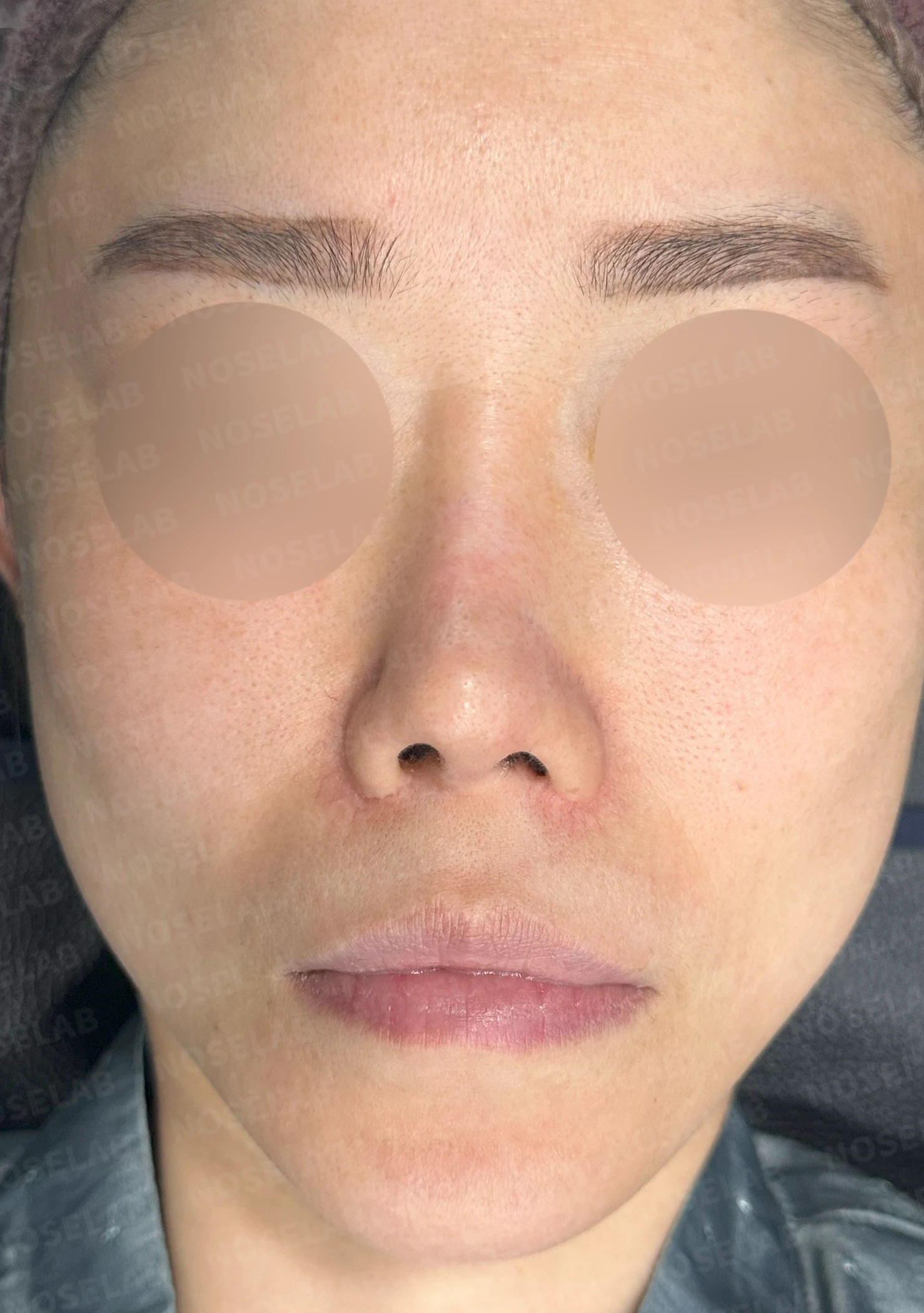 비공 비대칭과 들린코 교정 - 자가늑연골 재건 실제 후기 — 전(좌) 직후(우)