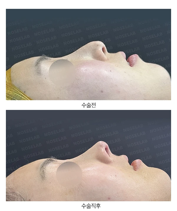 기능성 코성형 + 휘어진 비주 바로잡기 사례 — 전후 비교