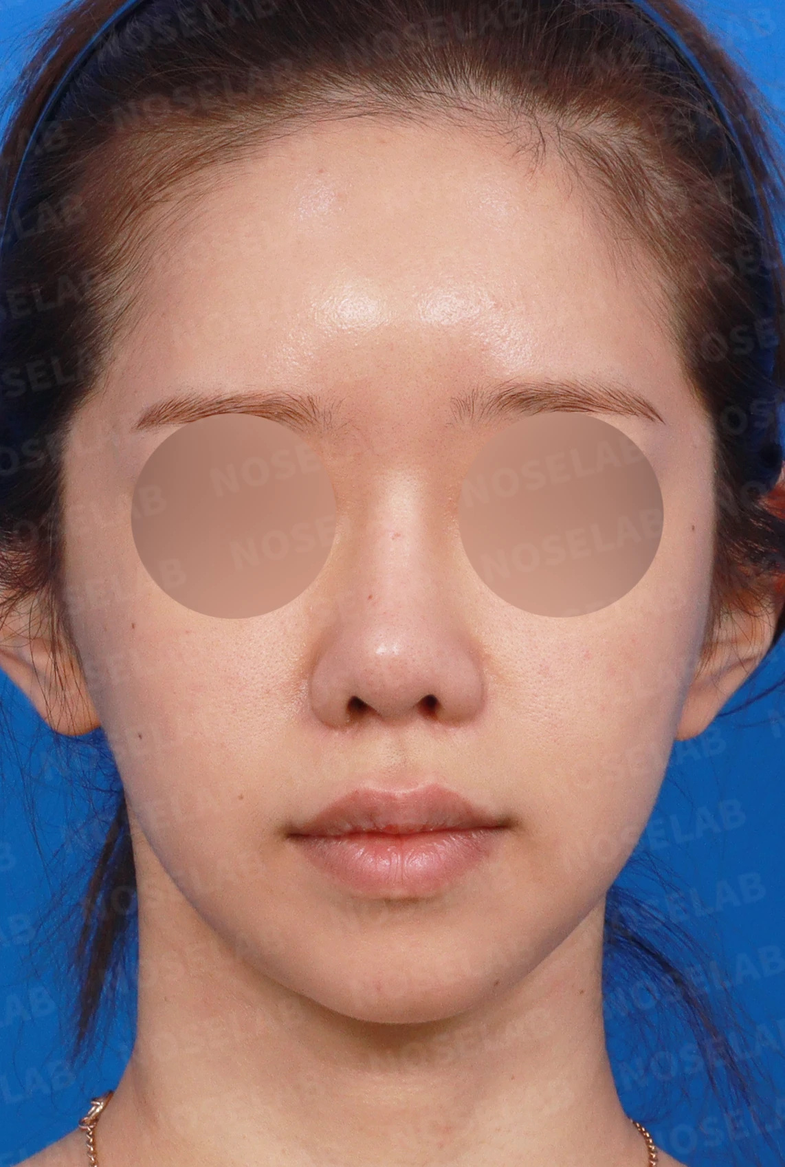 여러 차례 수술 뒤에도 코막힘과 휜 코가 남는 이유 — 디자인 상담 정면, 좌측 측면, 비스듬한 측면 사진입니다.