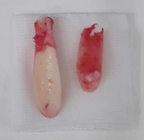 실리텍스 보형물이 비쳐 보이는 이유와 제거 후 재건은 어떻게 하나 — 본문 사진 11