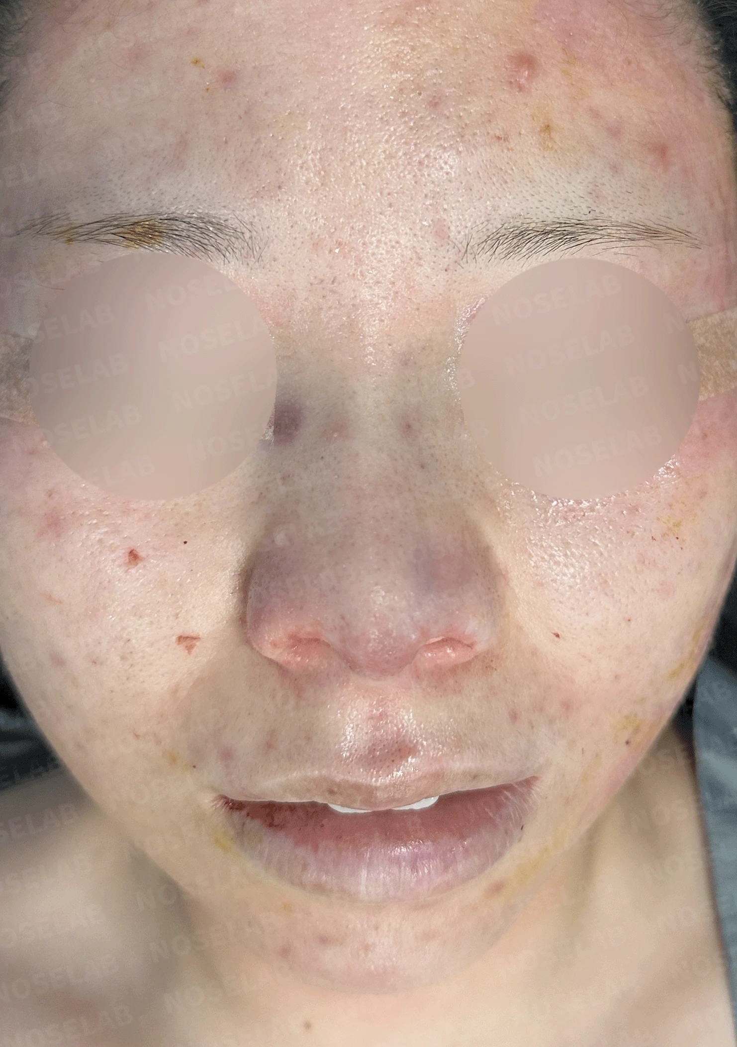 콧구멍을 막는 종괴가 생기는 이유, 제거와 재건은 어떻게 하나 — 수술 직후 0일 정면 , 비스듬한 측면 , 측면 사진입니다. 직후 사진은 부기가 있는 상태로 최종 결과와 다를 수 있습니다.