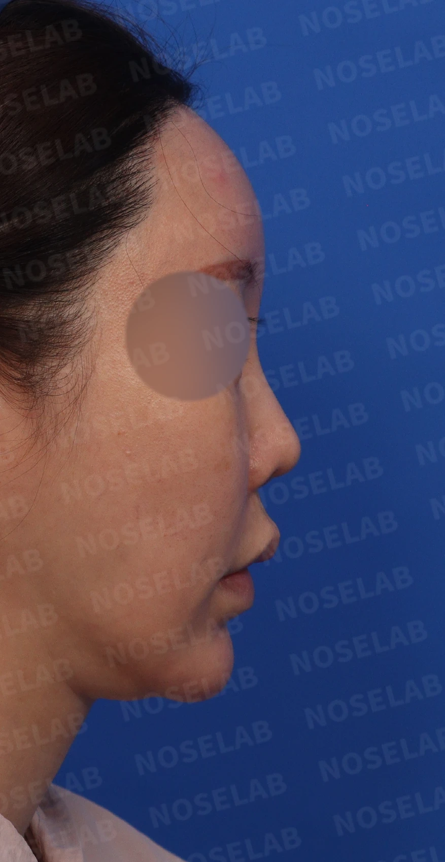 비주 함몰과 복코, 비공 비대칭의 교정 방법 — 정면, 측면, 비스듬한 측면