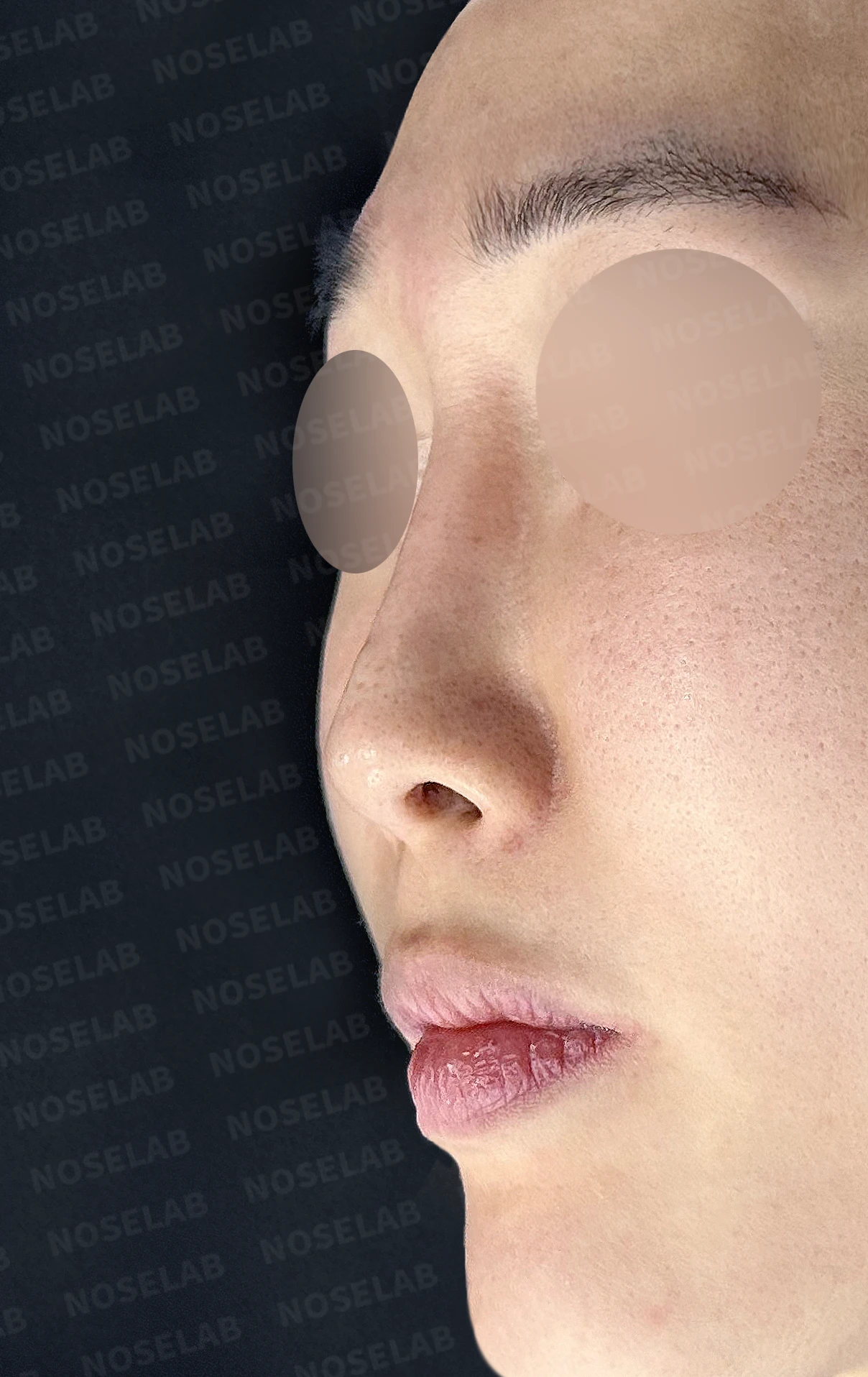 실리콘이 휘고 코가 길어 보이는 이유, 보형물 교체와 늑연골 재건은 어떻게 하나 — 수술 전 / 수술 직후 0일 직후 사진은 부기가 있는 상태로 최종 결과와 다를 수 있습니다.
