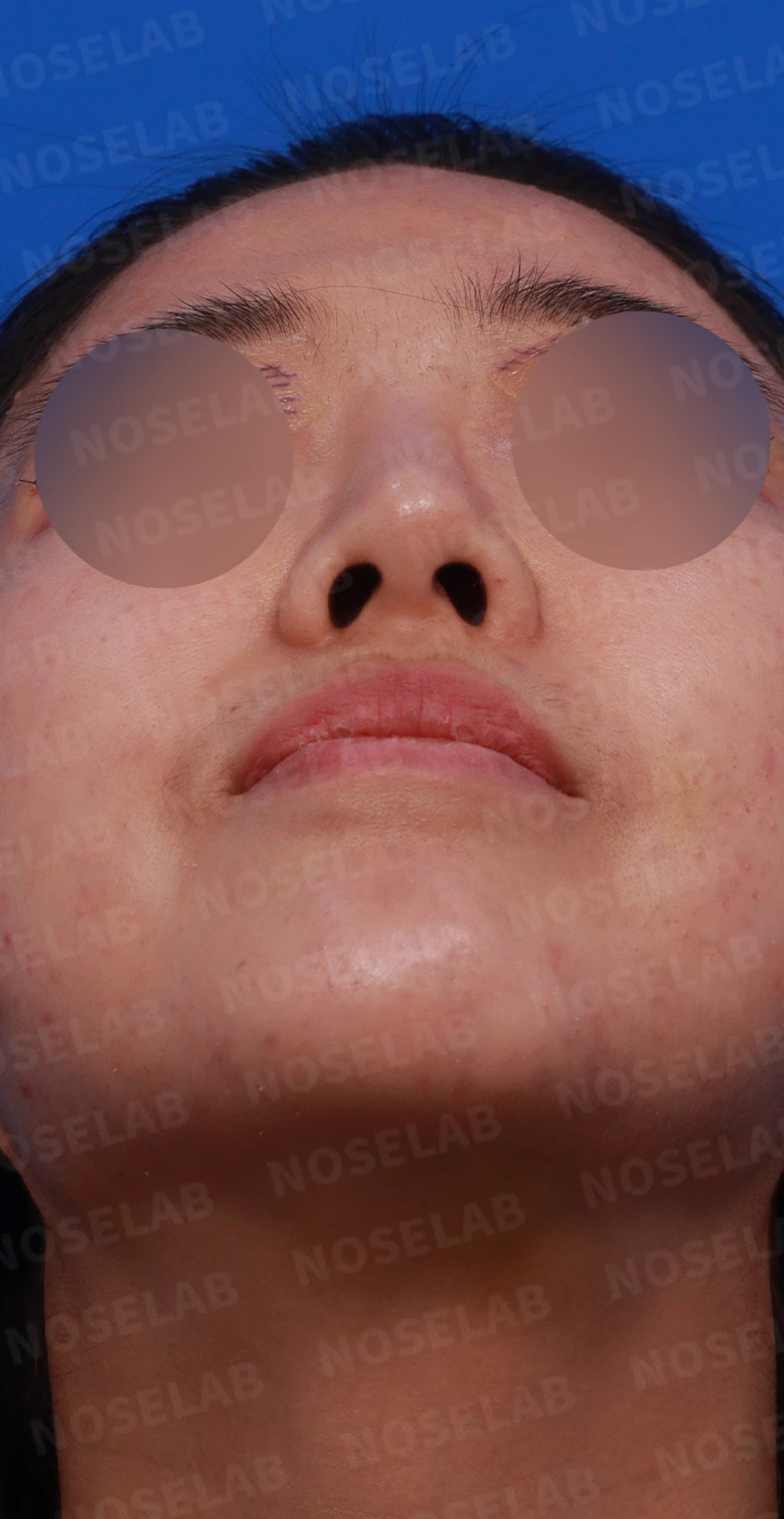 코필러 제거, 코막힘 해결 사례 — 디자인 상담 우측 비스듬한 측면, 측면, 비공 사진