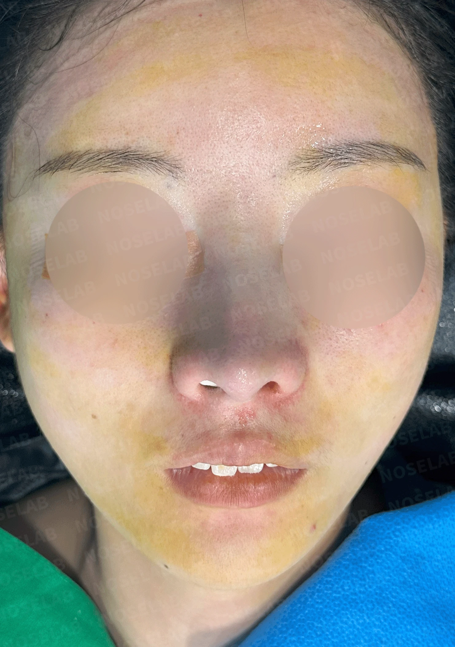 콧대가 인위적으로 보이고 코가 들리는 이유, 재건은 어떻게 하나 — 수술 직후 0일 정면 , 비스듬한 측면 사진, 측면 사진 직후 사진은 부기가 있는 상태로 최종 결과와 다를 수 있습니다.