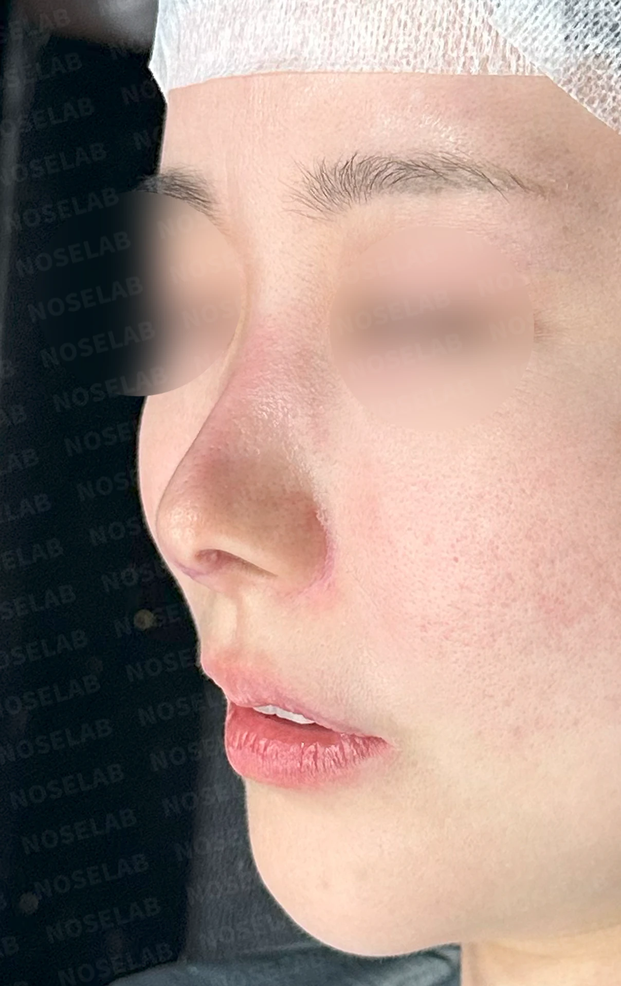 코성형 후 남는 미세한 높이 부족과 좌우 비대칭, 왜 생기고 어떻게 보강하나 — 수술 전 / 수술 직후 0일 직후 사진은 부기가 있는 상태로 최종 결과와 다를 수 있습니다.