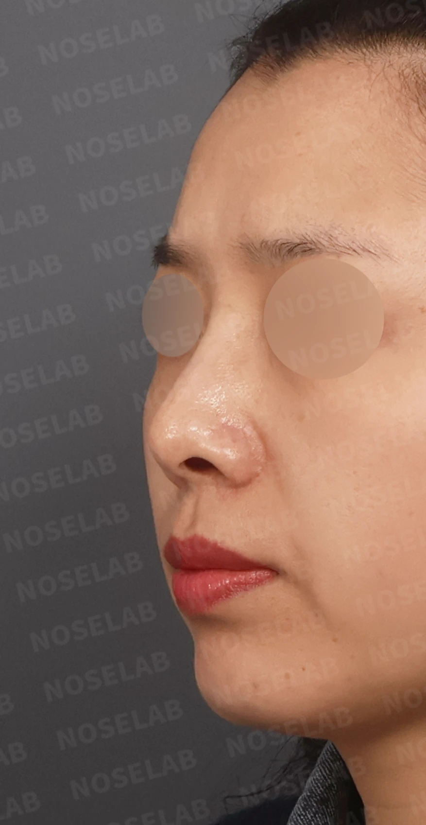 비공 비대칭과 휘어진 코, 자가늑연골 재건으로 교정한 코재수술 — 디자인 상담 정면, 좌측 측면, 비스듬한 측면 사진