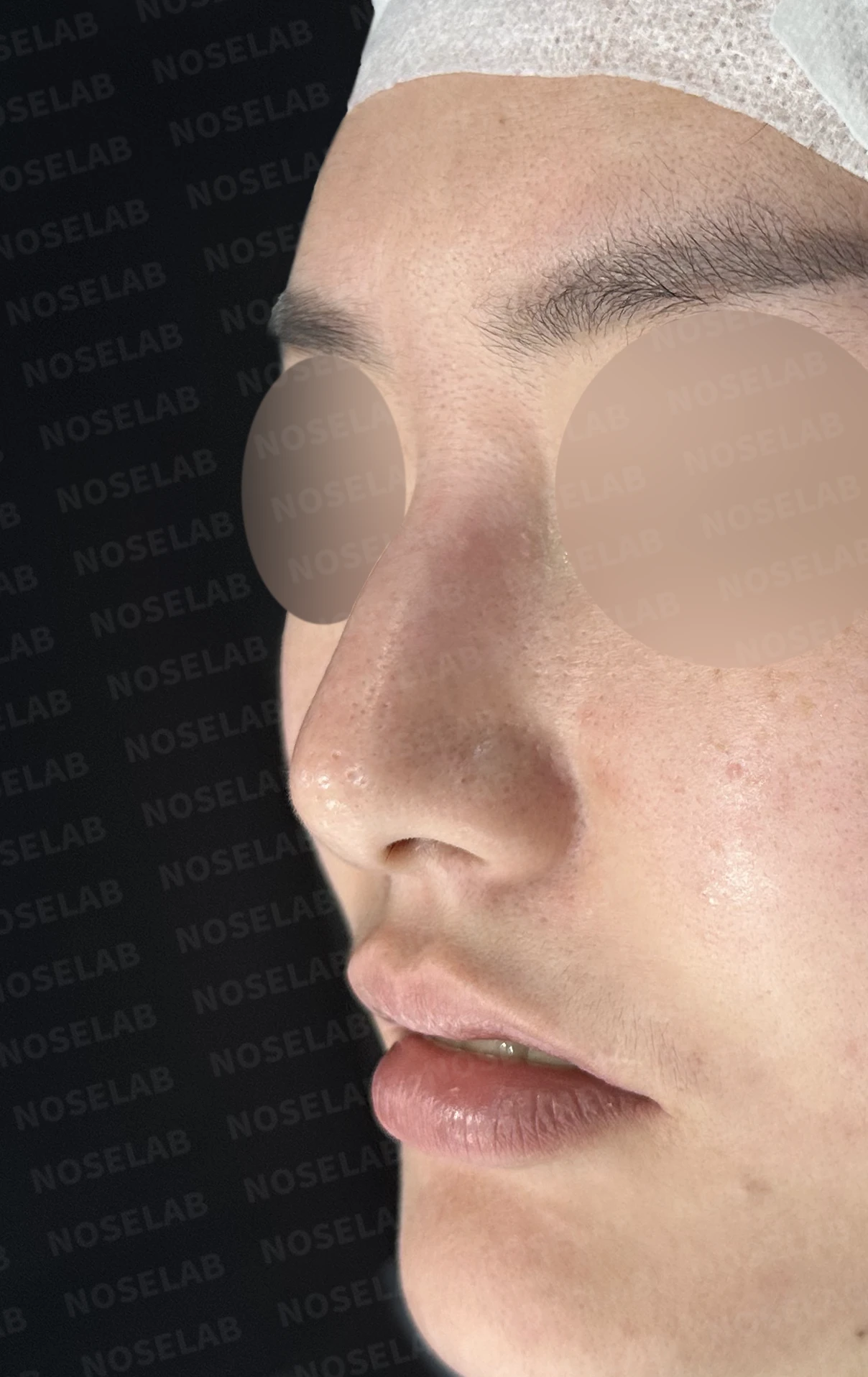 매부리코 교정, 자가늑연골로 자연스러운 코 라인 완성 — 전(좌) 직후(후)