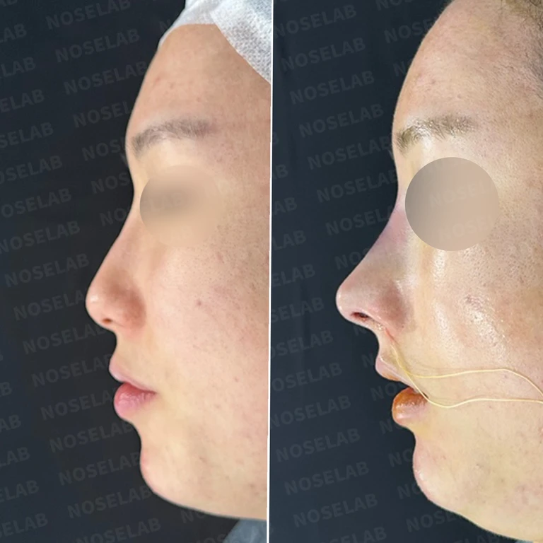 코 필러 뒤에도 휜 코와 코막힘이 남는 이유, 교정은 어떻게 하나 — 전후 비교