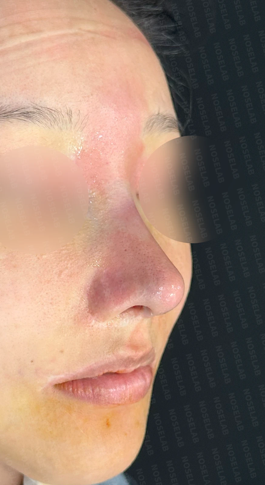퍼진 코와 중안면부 비율을 고려한 교정 방법 — 수술 직후 0일 정면, 측면, 비스듬한 측면 사진입니다. 직후 사진은 부기가 있는 상태로 최종 결과와 다를 수 있습니다.