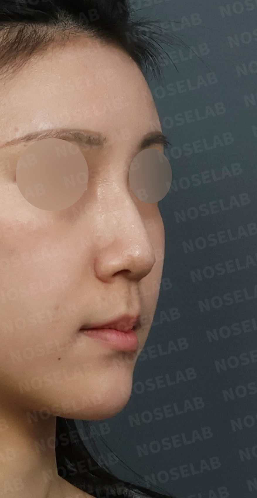 코필러 제거 후 자가늑연골 코성형, 처진 코끝과 메부리코를 자연스럽게 교정 — 디자인 상담 우측 측면, 비스듬한 측면, 비공 사진입니다.