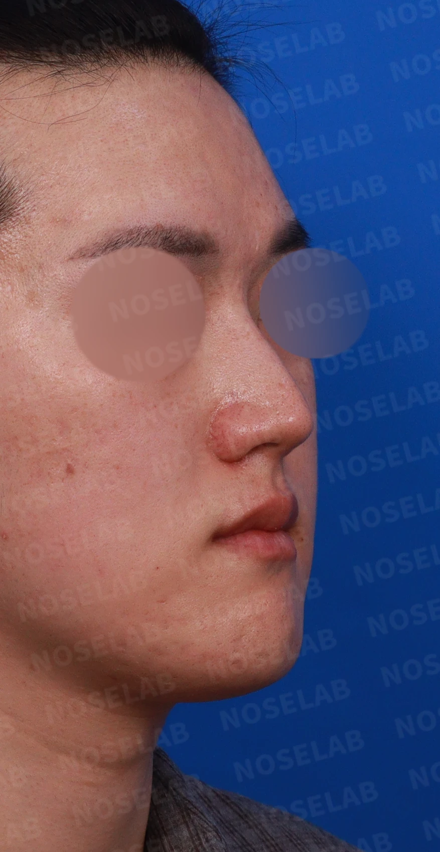 보형물 없이 코끝과 경계 부분만 교정하는 방법 — 디자인 상담 비스듬한 측면 , 우측 측면, 비공 사진
