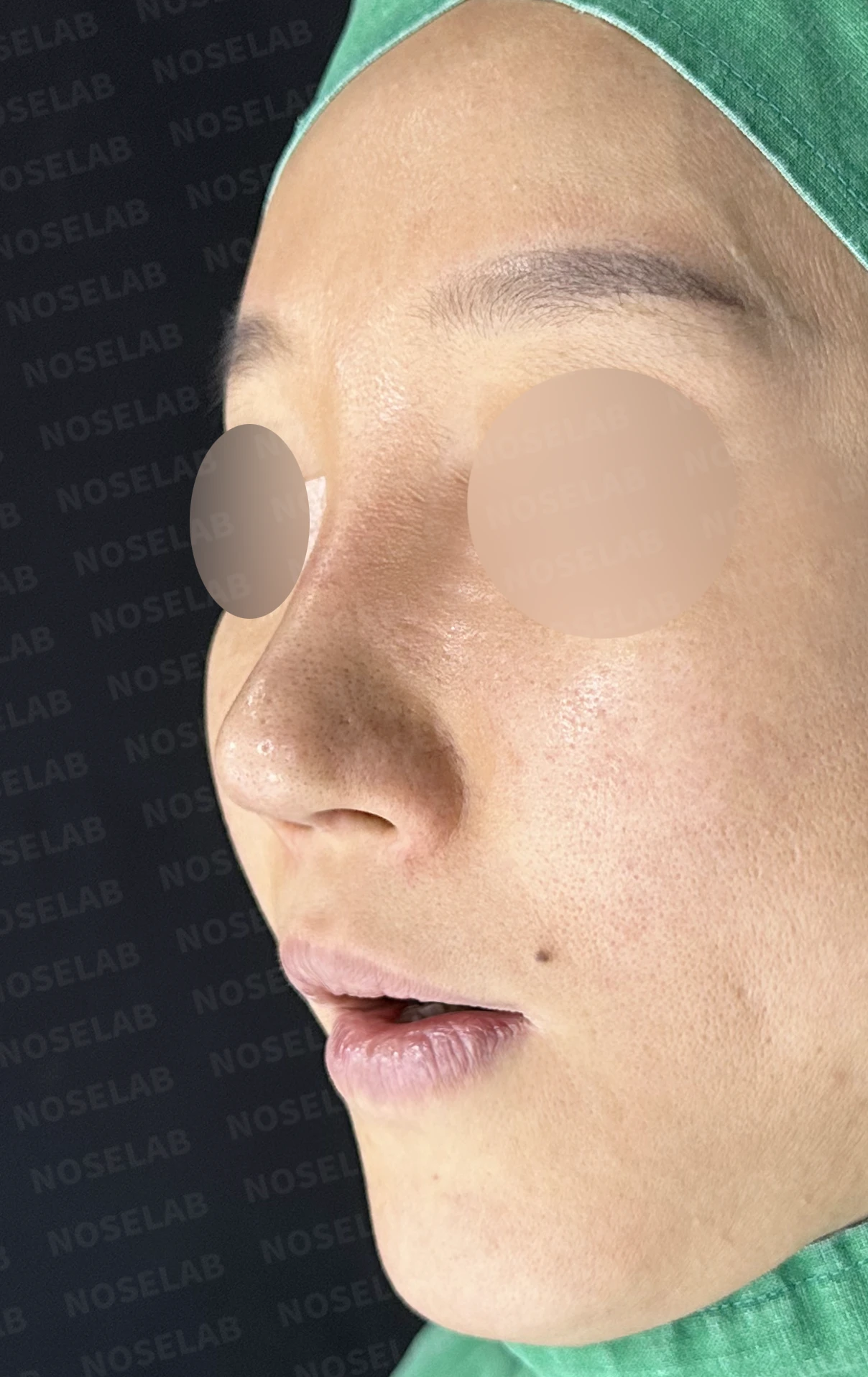 여러 번의 코재수술 뒤 비중격이 무너지는 이유, 자가늑연골 전면 재건은 어떻게 하나 — 수술 전 / 수술 직후 0일 직후 사진은 부기가 있는 상태로 최종 결과와 다를 수 있습니다.