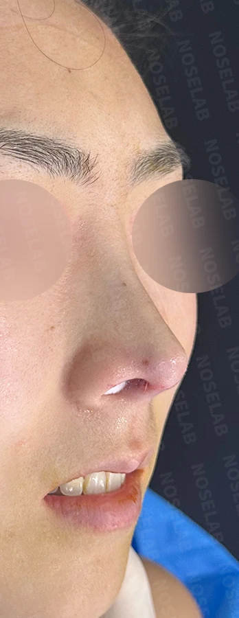 기능성 코성형·휘어진 비주 바로잡기 방법 — 수술 직후 0일 사진 90도 측면, 45도 측면, 정면 직후 사진은 부기가 있는 상태로 최종 결과와 다를 수 있습니다.