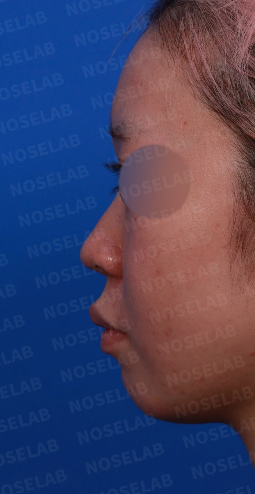 퍼진코, 복코 교정으로 균형 잡힌 이미지 완성 — 디자인 상담 좌측 비스듬한 측면, 측면, 비공 사진입니다.