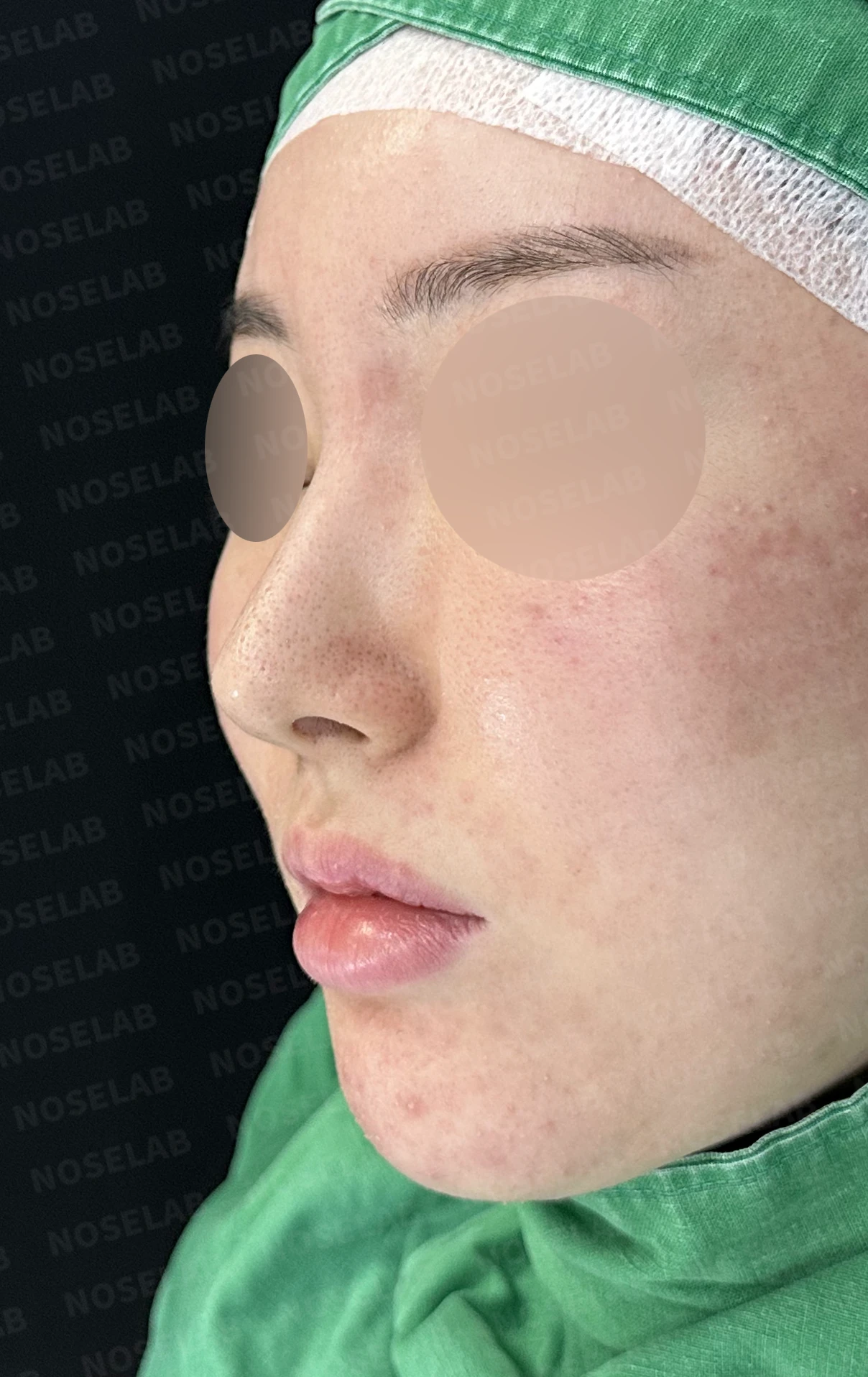 코가 길어 보이고 비주가 휘는 이유, 비중격 연장과 재건은 어떻게 하나 — 수술 전 / 수술 직후 0일 직후 사진은 부기가 있는 상태로 최종 결과와 다를 수 있습니다.