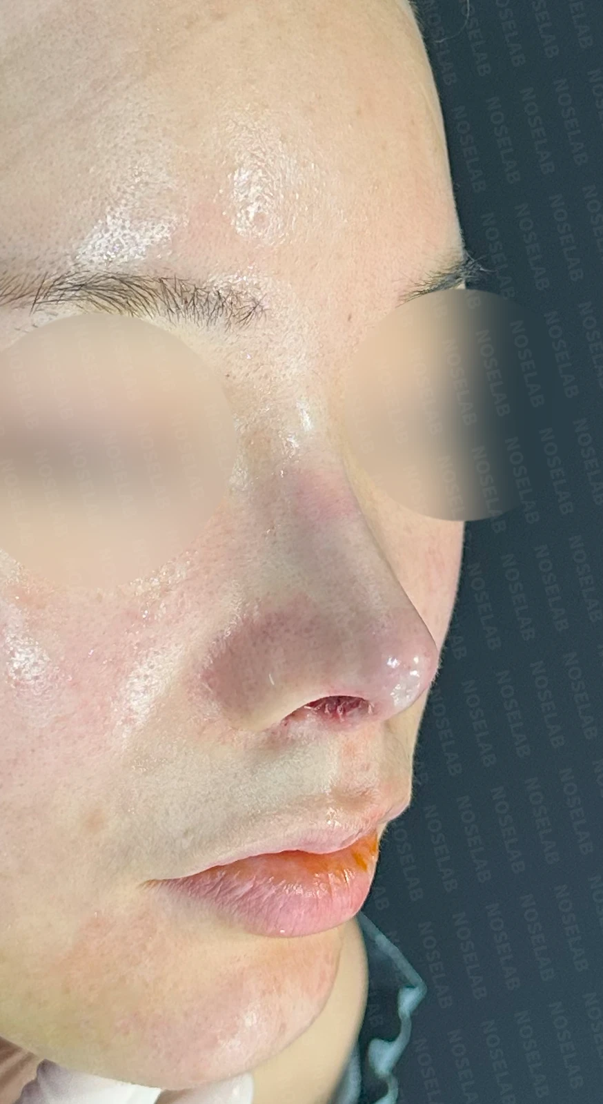 코끝 피부 상태와 괴사 위험을 고려한 재수술 계획 — 수술 직후 0일 사진 정면, 측면, 비스듬한 측면 입니다. 직후 사진은 부기가 있는 상태로 최종 결과와 다를 수 있습니다.