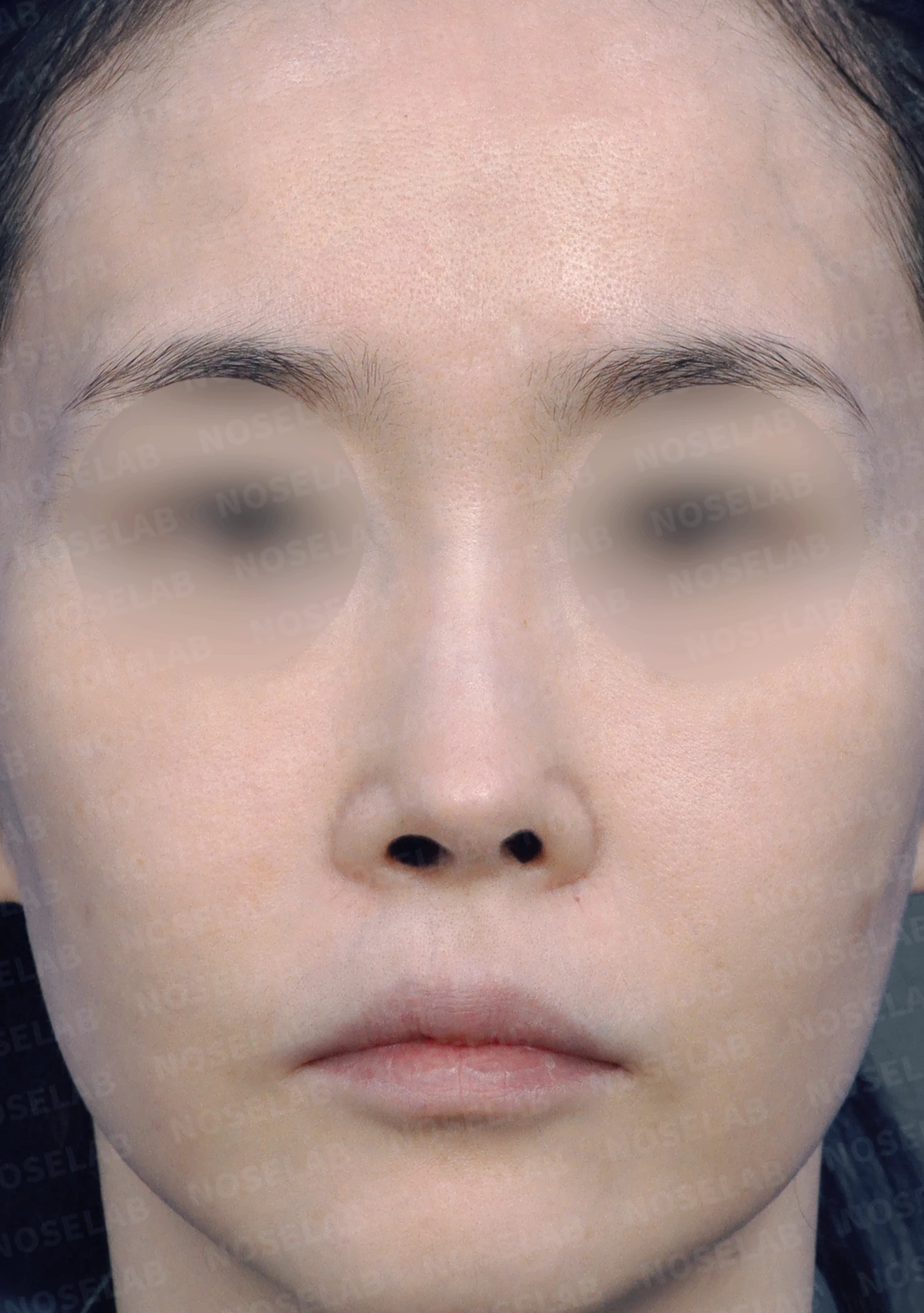 휜코와 콧구멍 비대칭의 재수술 방법 — 수술 전 / 수술 직후 0일 직후 사진은 부기가 있는 상태로 최종 결과와 다를 수 있습니다.