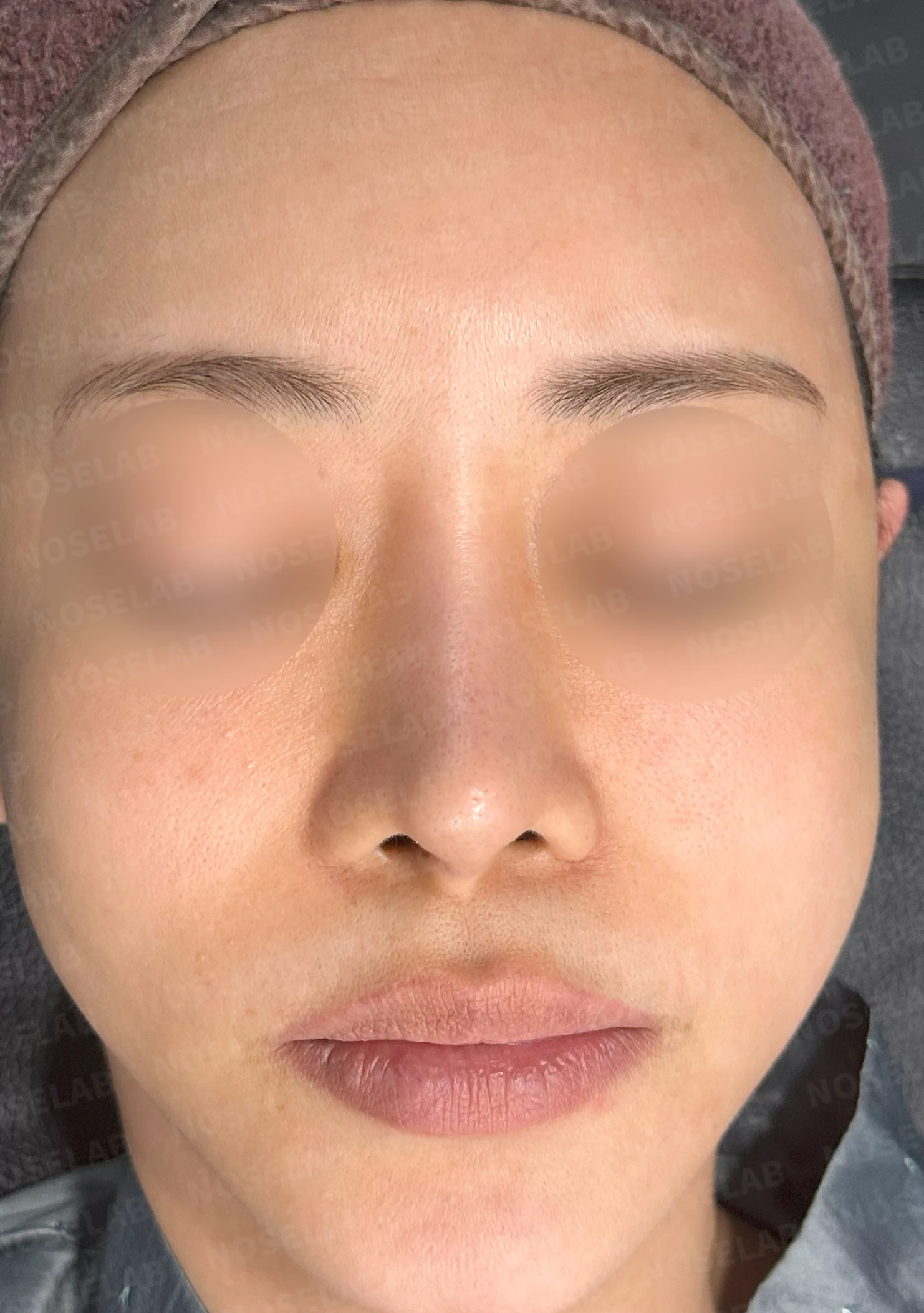 들린코와 시작점 내리고 화려하게 수술사례 — 전(좌) 직후(우)