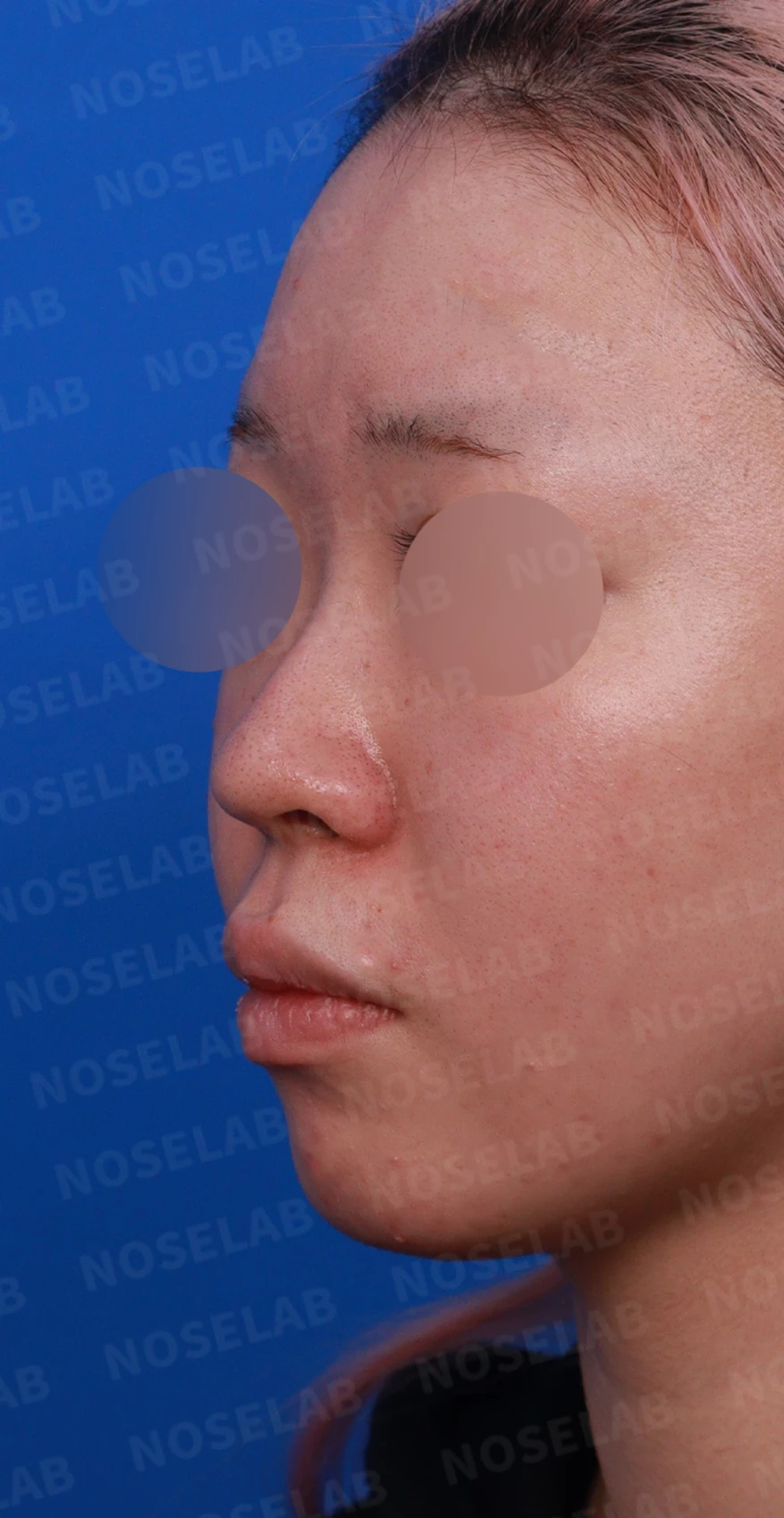 퍼진코, 복코 교정으로 균형 잡힌 이미지 완성 — 디자인 상담 좌측 비스듬한 측면, 측면, 비공 사진입니다.