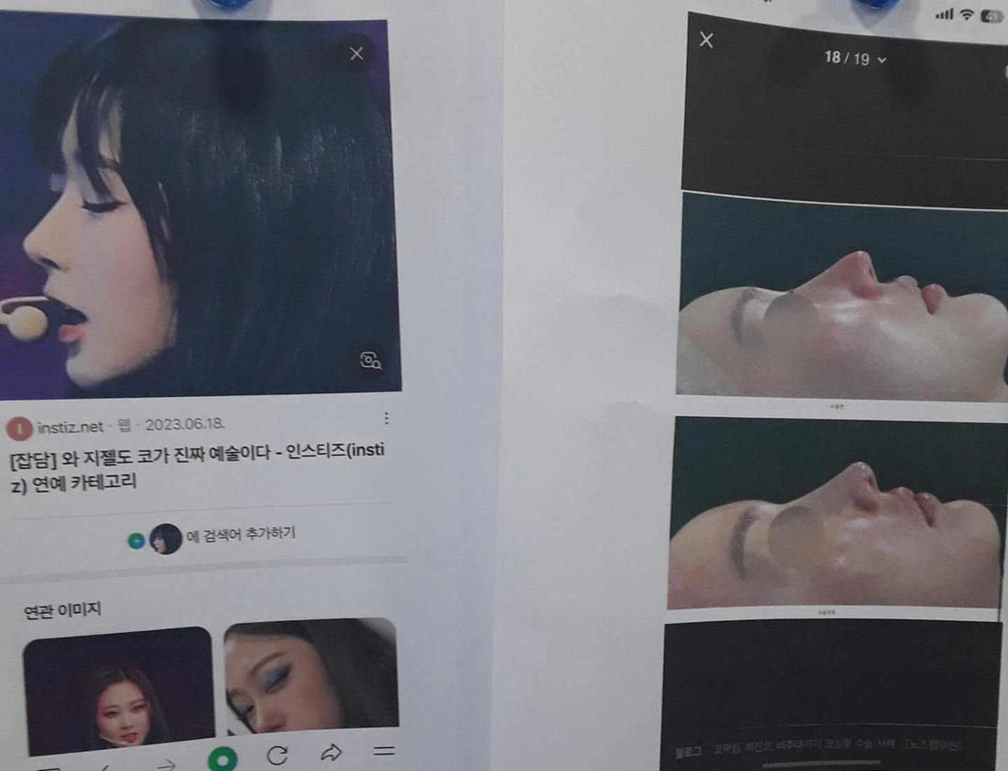 뭉툭하게 퍼진 코끝이 생기는 이유, 자가 늑연골 비중격 연장으로 직반 라인을 만드는 방법 — 본문 사진 7